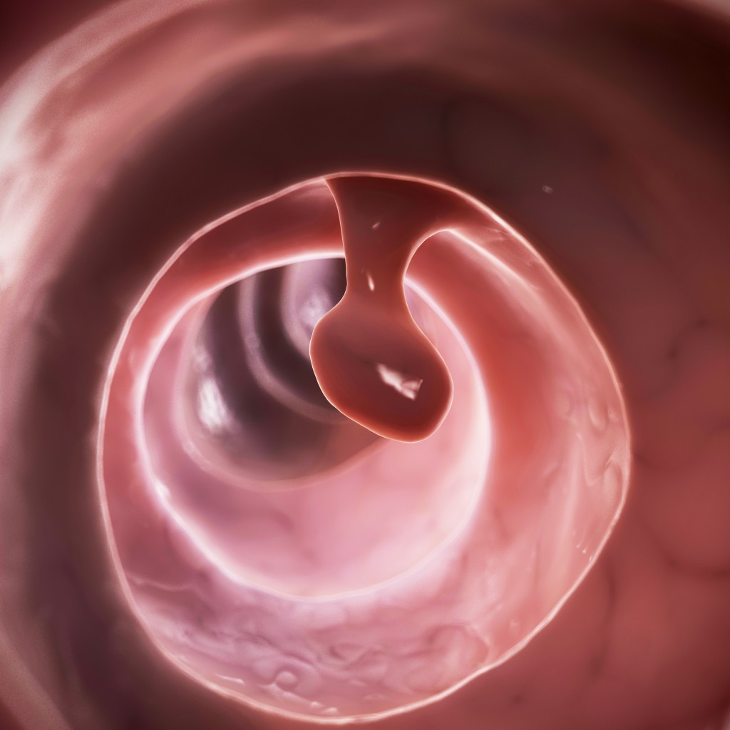 Home Dna Test >> Novel Non-invasive Screening of Colon Cancer Highlighted As Alternative to Colonoscopy for ... Home Dna Test >> Novel Non-invasive Screening of Colon Cancer Highlighted As Alternative to Colonoscopy for ...